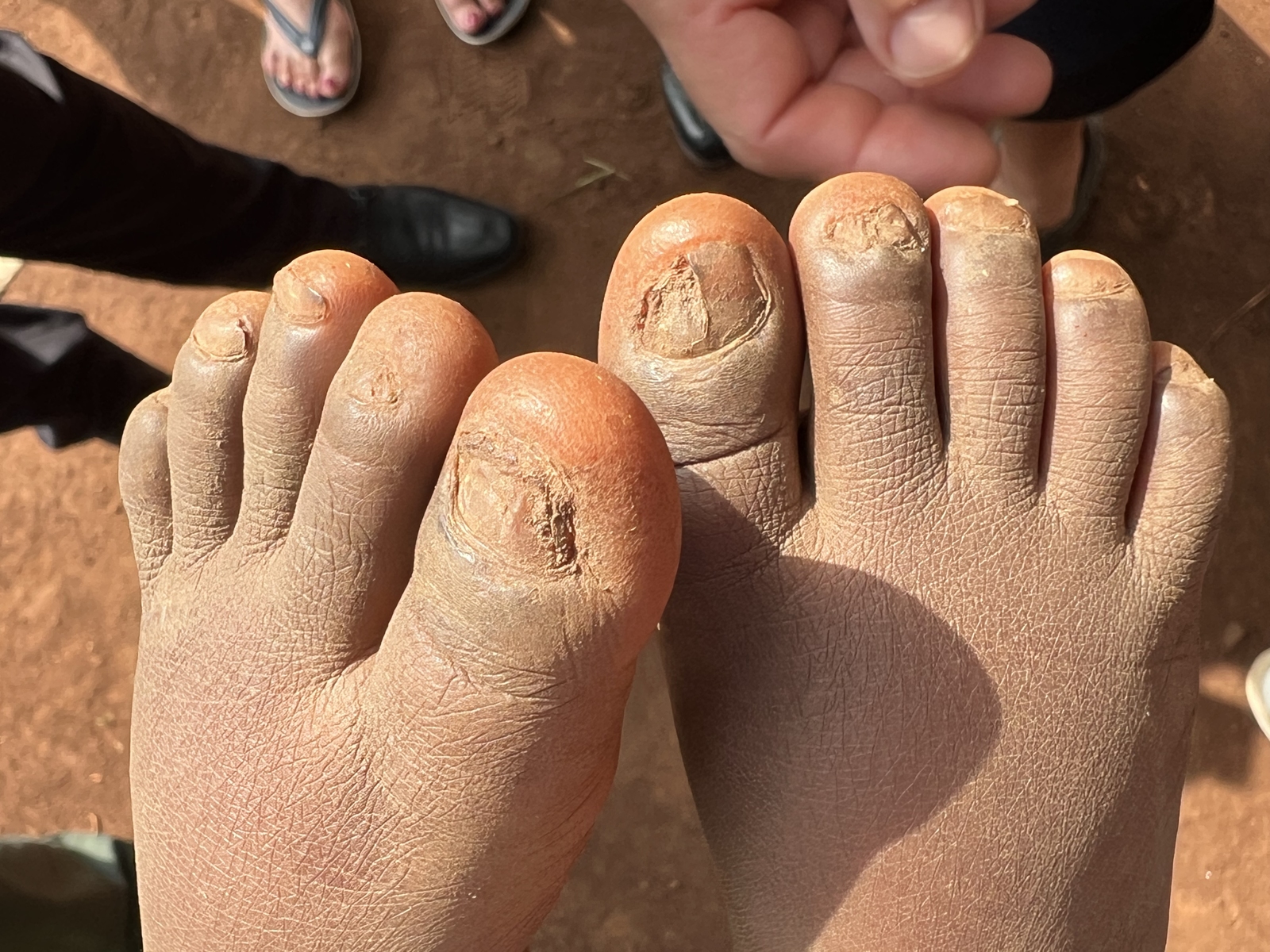 2024, tungiasis, sandflohkrankheit, uganda